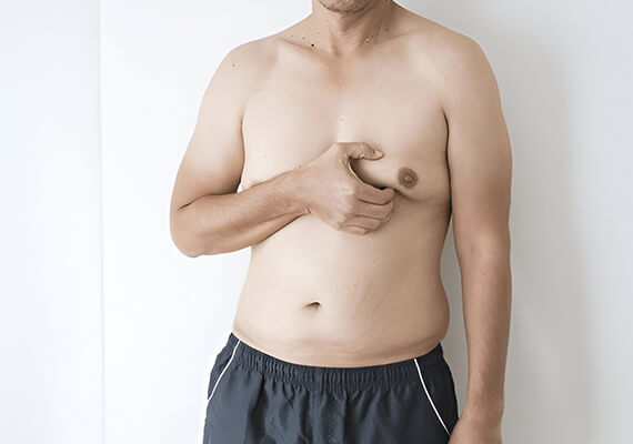 What Is Gynecomastia and Why Does It Occur