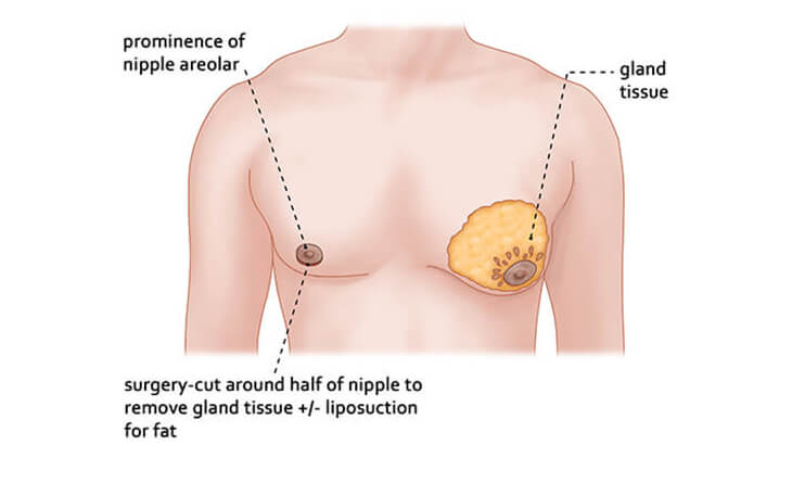 Can Gynecomastia Be Treated Without Surgery - Dr Lokesh Handa - Plastic Surgeon in Delhi - Gynecomastia surgery -03 gynecomastia surgery