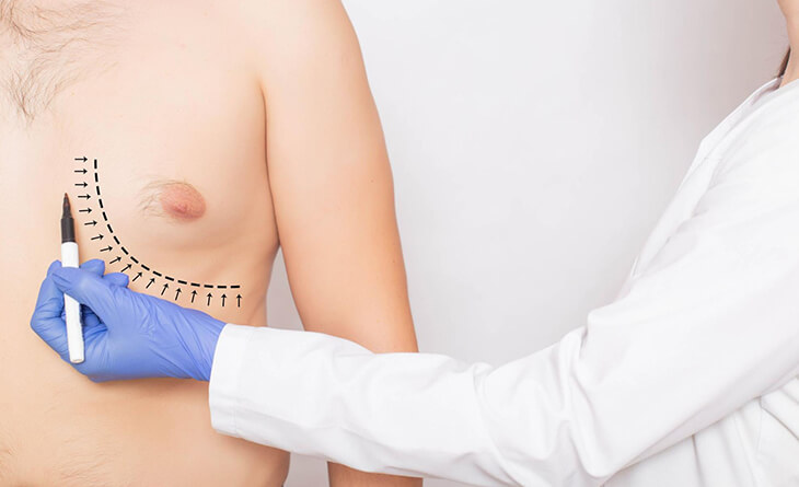 gynecomastia surgery