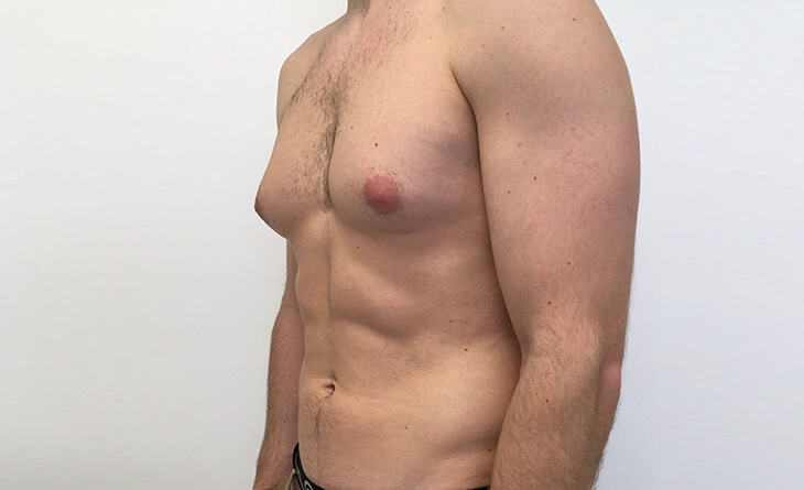 gynecomastia surgery