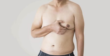 gynecomastia surgery