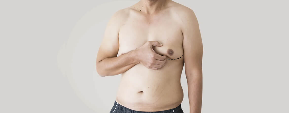 gynecomastia surgery